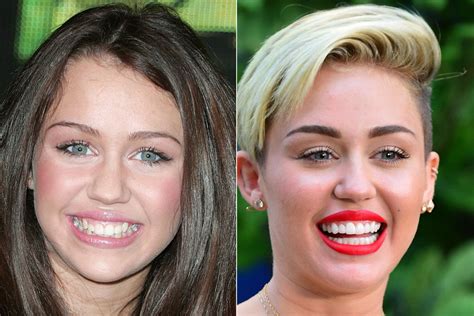 before and after celebrity teeth